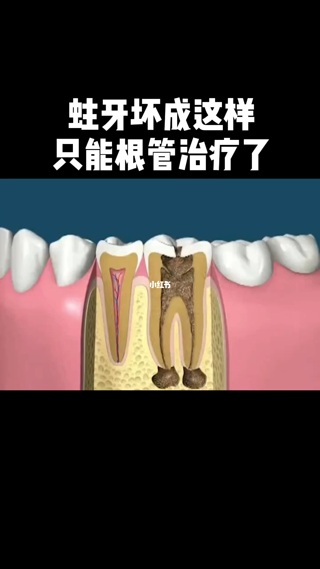 牙齿做了根管治疗可以补牙吗_做根管后牙能用多少年_牙齿做了根管后能用几年