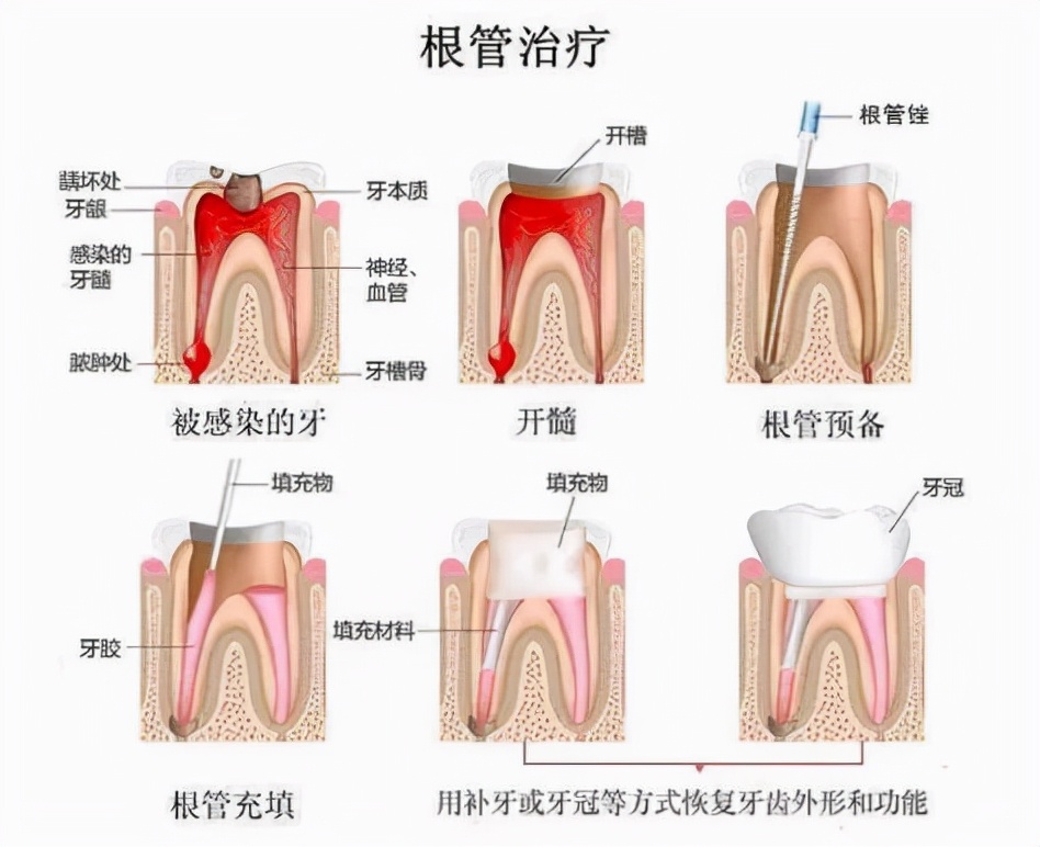 牙齿做了根管治疗可以补牙吗_牙齿做了根管后能用几年_做根管后牙能用多少年