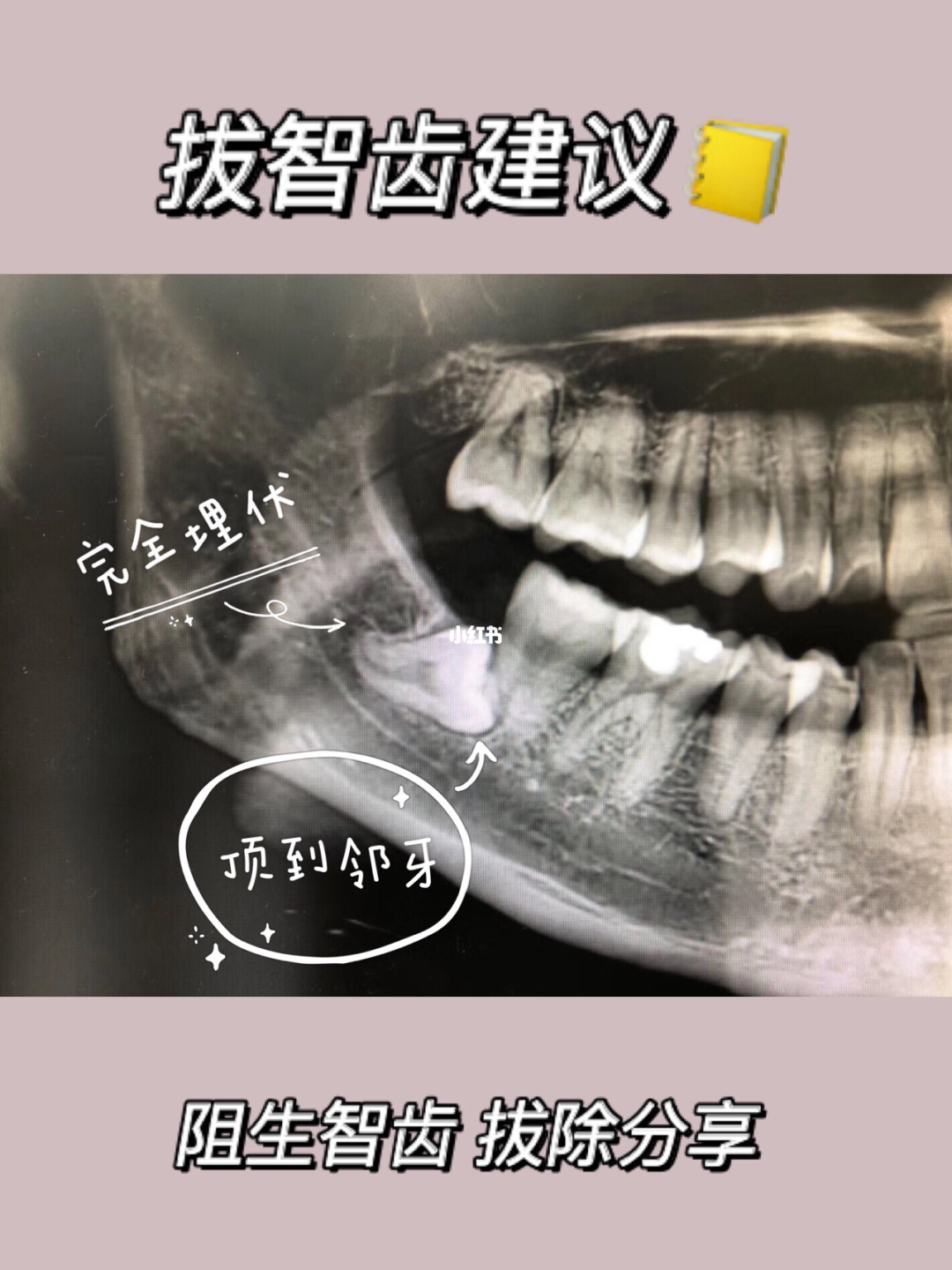 隐形牙图片大全_隐形义齿效果图_单颗活动隐形义牙图片